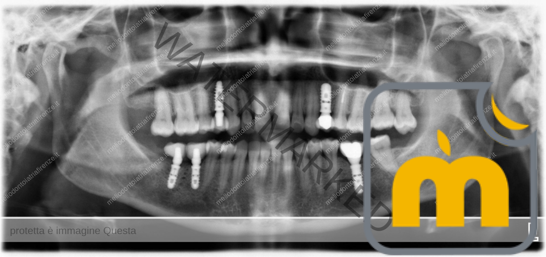 Impianti Dentali a Firenze